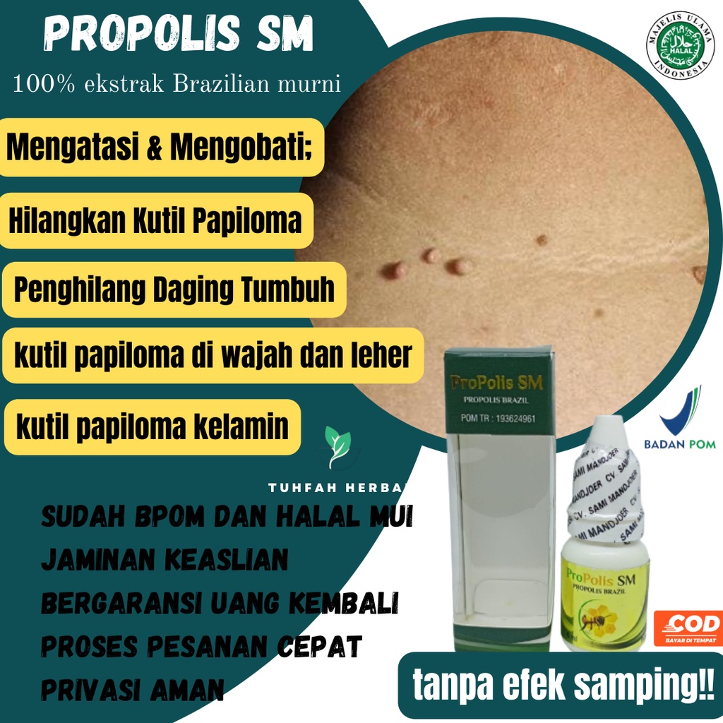 Obat Papiloma Di Wajah Papiloma Kelamin Papiloma Leher Papiloma dan Parasit Papiloma dan Kutil Obat 