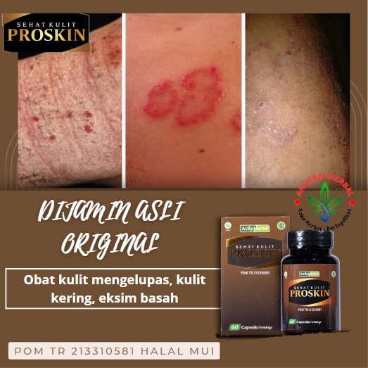Obat kulit mengelupas, perawatan kulit kering, obat eksim basah, obat kulit tangan mengelupas, kulit