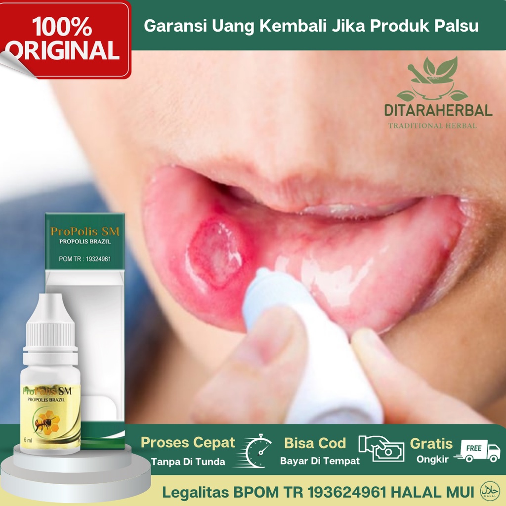 Obat Sariawan, Obat Tetes Sariawan, Obat Luka Sariawan, Obat Oles Sariawan Mulut, Obat Sariawan Peri