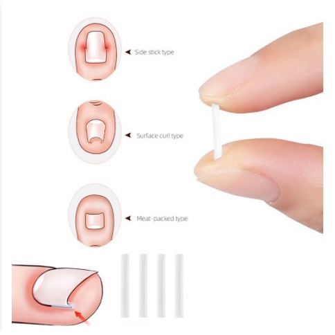 1pcs Bantalan Silikon koreksi Kuku Ingrown Nail Isolation Pad kuku