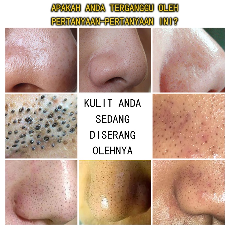 Acne gel jerawat Mengecilkan Pori pori besar Serum wajah 30G Menyegarkan kontrol minyak komedo mengecilkan pori-pori Meningkatkan jerawat dan kulit kasar Melembabkan dan meremajakan Menghilangkan jerawat, komedo, pori-pori besar