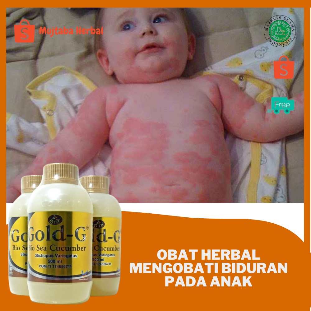 OBAT HERBAL BIDURAN ALAMI UNTUK ANAK  Obat Biduran Anak, Alergi, Kaligata Akut, Gatal-Gatal, Kaligat
