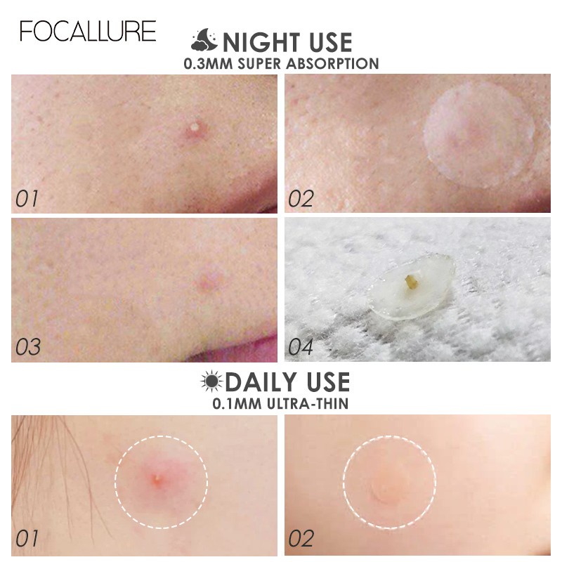 Focallure Spot Acne Patch Treatment Day/Night Waterproof Smooth