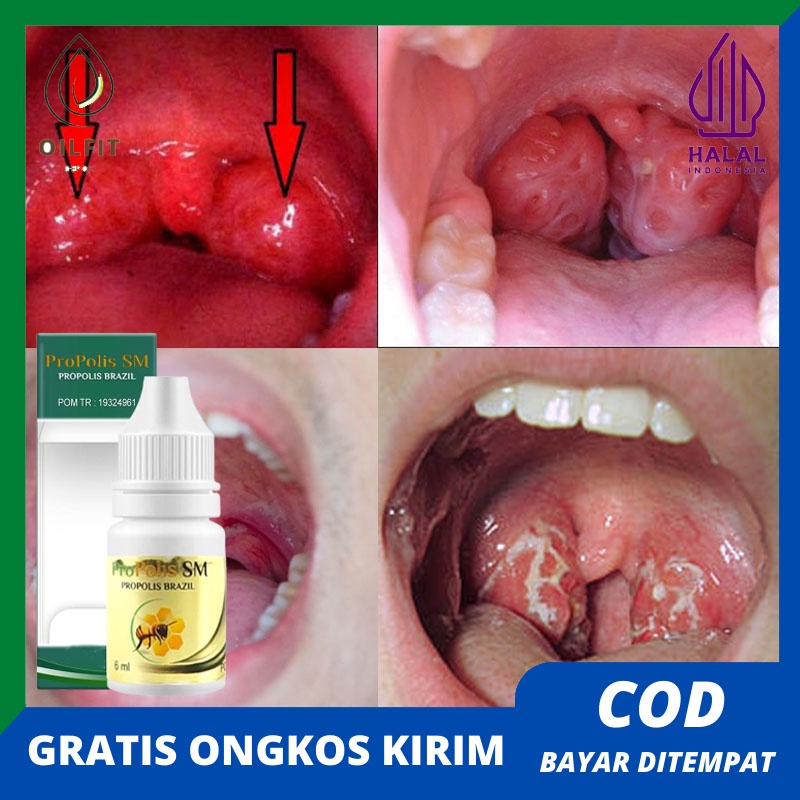 Obat Amandel Anak Dan Dewasa Menahun Parah Bengkak Atasi Dengan Herbal Propolis Sm Bisa COD
