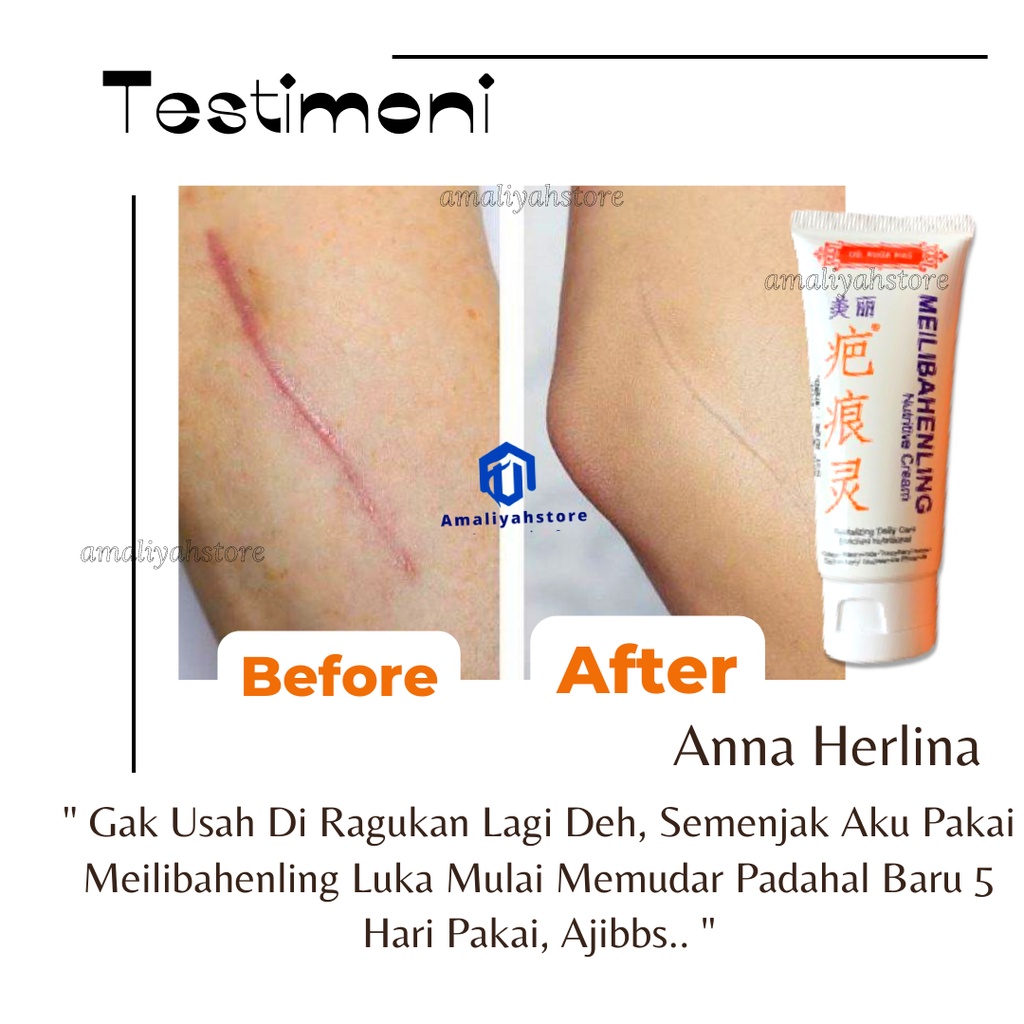 Meilibahenling Nutritive Lotion Cream Obat Penghilang Bekas Luka Diabetes Krim Salep Flek Hitam Gatal Jamur Koreng Membandel Agar Cepat Kering Untuk Anak Dan Dewasa Paling Ampuh 100% Original Bpom