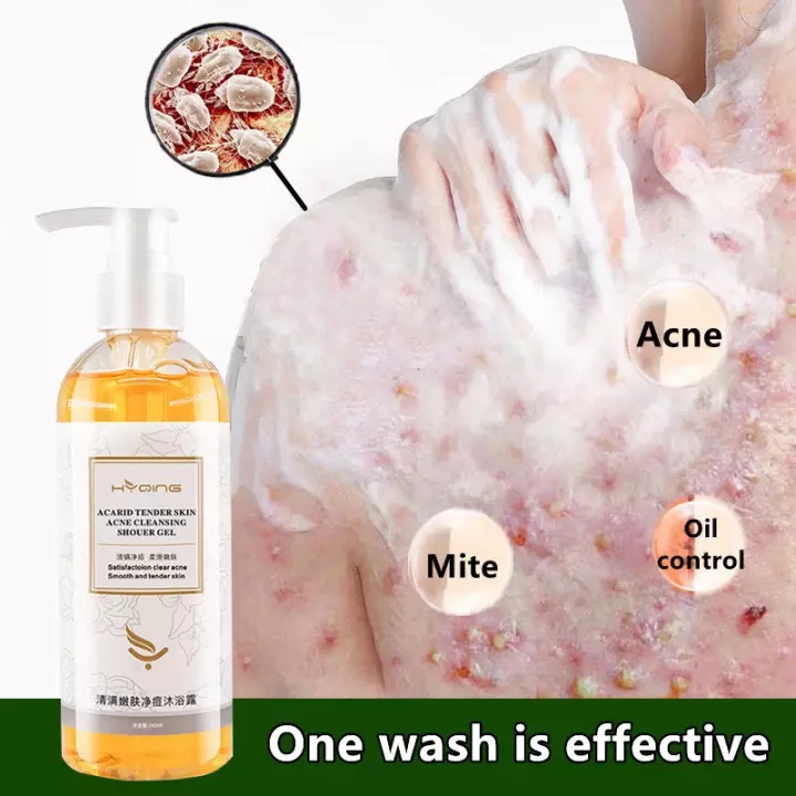 Body Wash Acne Whitening 260ml Shower Gel Untuk Perawatan Eksim dan Menghilangkan Tungau &amp; Kurap Kulit dan Antibakteri &amp; Jerawat Cuci Tubuh 100% Perawatan Herbal Alami