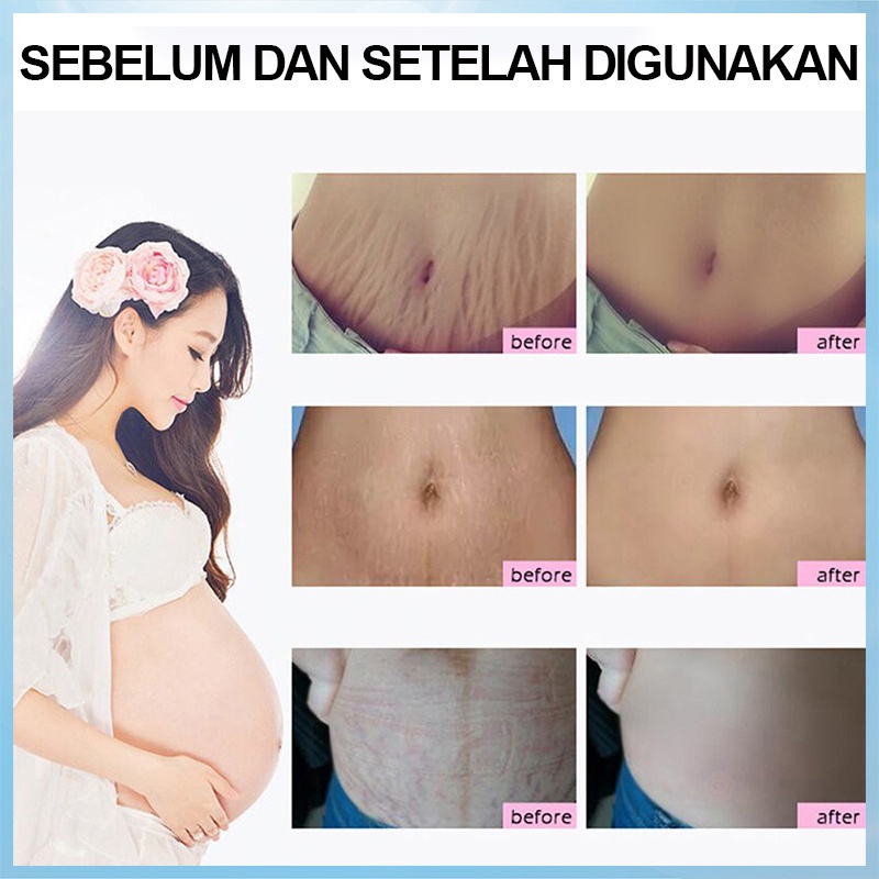 Strechmark Cream Pregnancy Cream Krim Stretch Mark Penghilang Strechmark 60g Krim penghilang bekas luka Krim perbaikan kerut untuk wanita hamil untuk memudarkan luka bakar dan luka bedah untuk menghilangkan bekas luka abadi Perawatan Tubuh