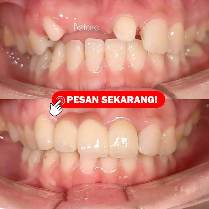 PROMO GIGI PALSU PENAMBAL GIGI PATAH RENGGANG TEMPO BUTIR PENAMBAL GIGI TAMBAL GIGI PENAMBAL GIGI GI