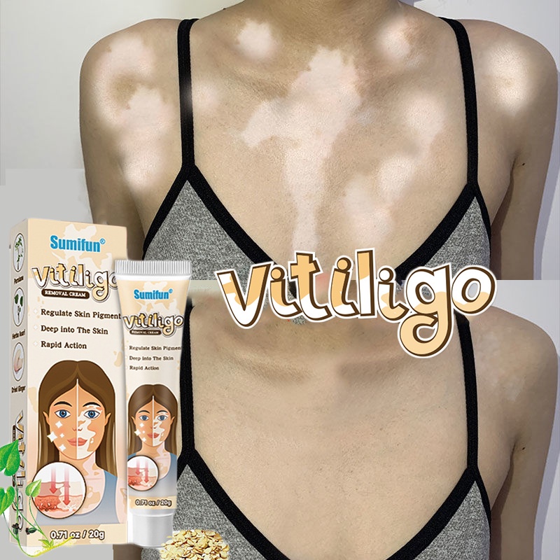 Salep vitiligo Obat vitiligo paling ampuh 100% Obat vitiligo Obat bercak putih pada kulit Protopic v