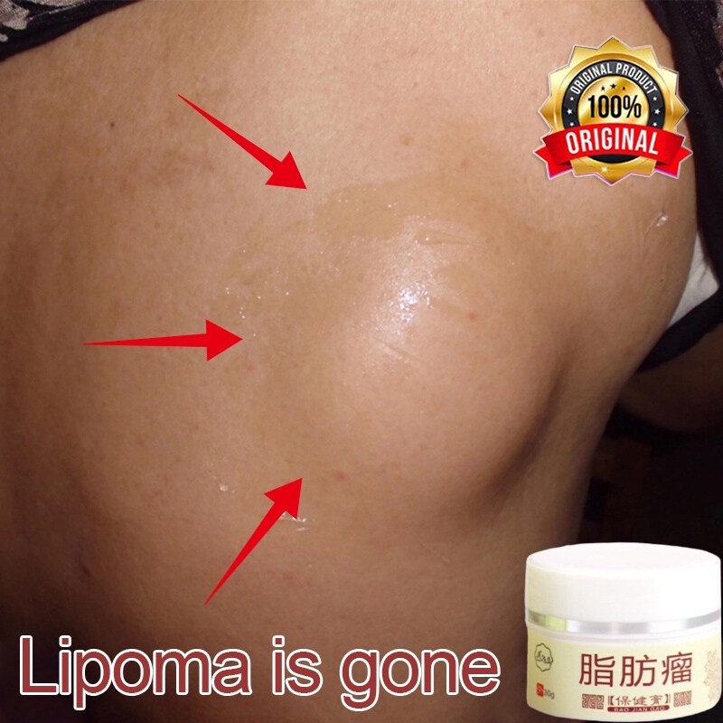 Obat Benjolan Lipoma Krim lipoma Obat oles penghilang  Benjolan  lipoma 30g Obat Kista Ganglion/Obat