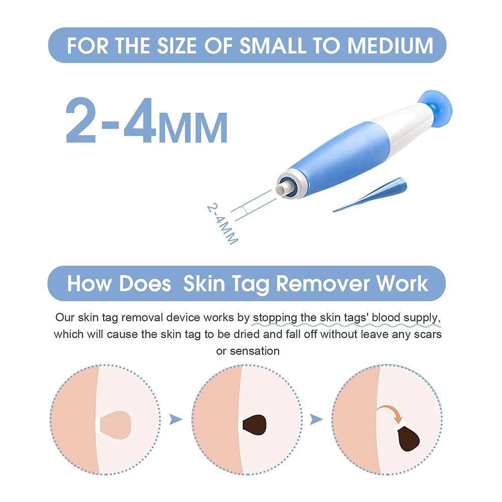 Alat Penghilang Kutil Painless Skin Tag Mole Removal Kit - LGV40 - Blue