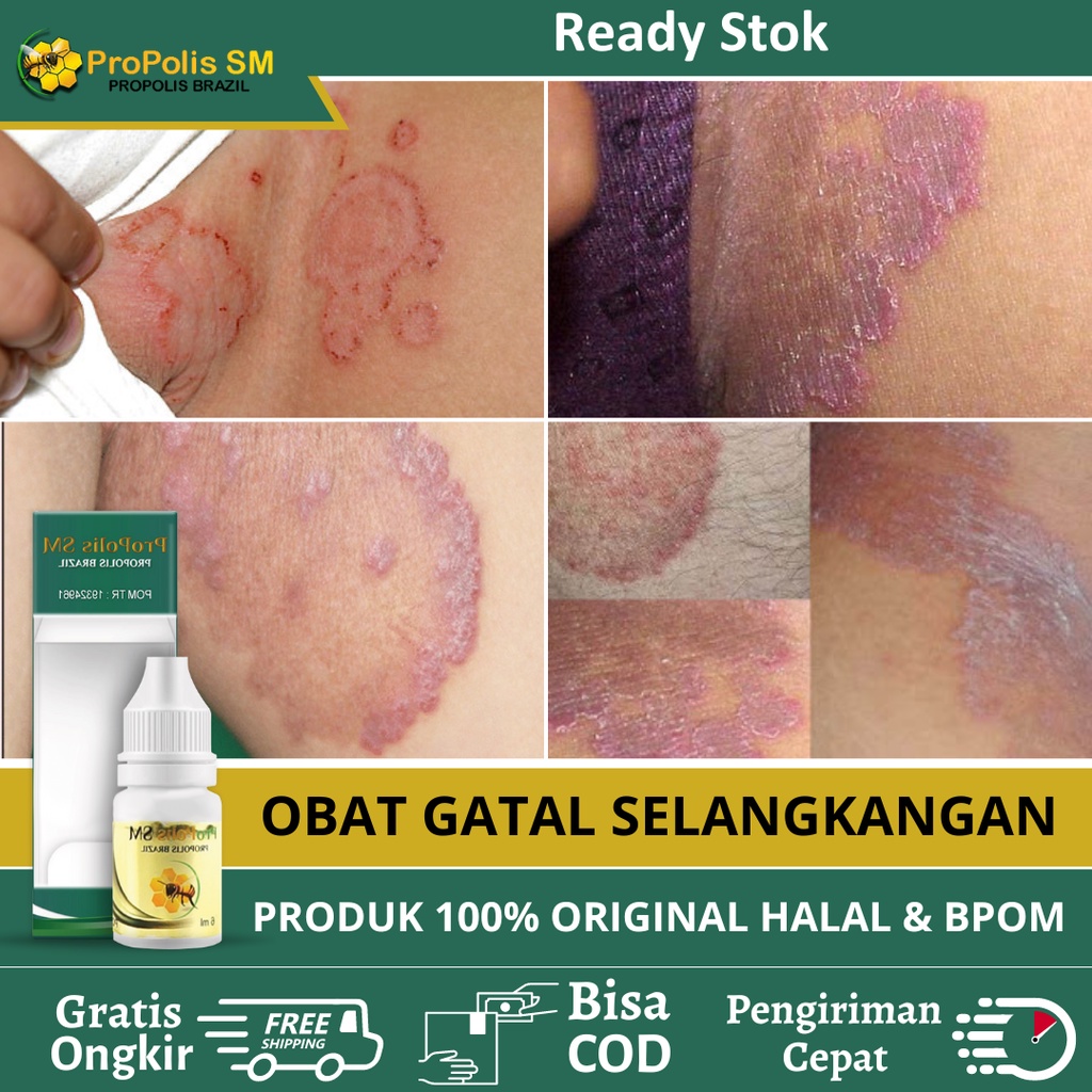 Obat Selangkangan Hitam, Obat Gatal Selangkangan Pria Wanita, Obat Infeksi Jamur Selangkangan, Obat 