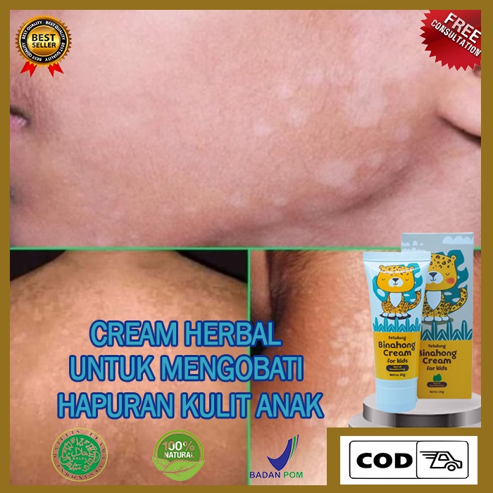 Cream Untuk Hapuran Kulit, Penghilang Bercak Putih Di Kulit Anak, Menghilangkan Panu Hapuran Dengan 