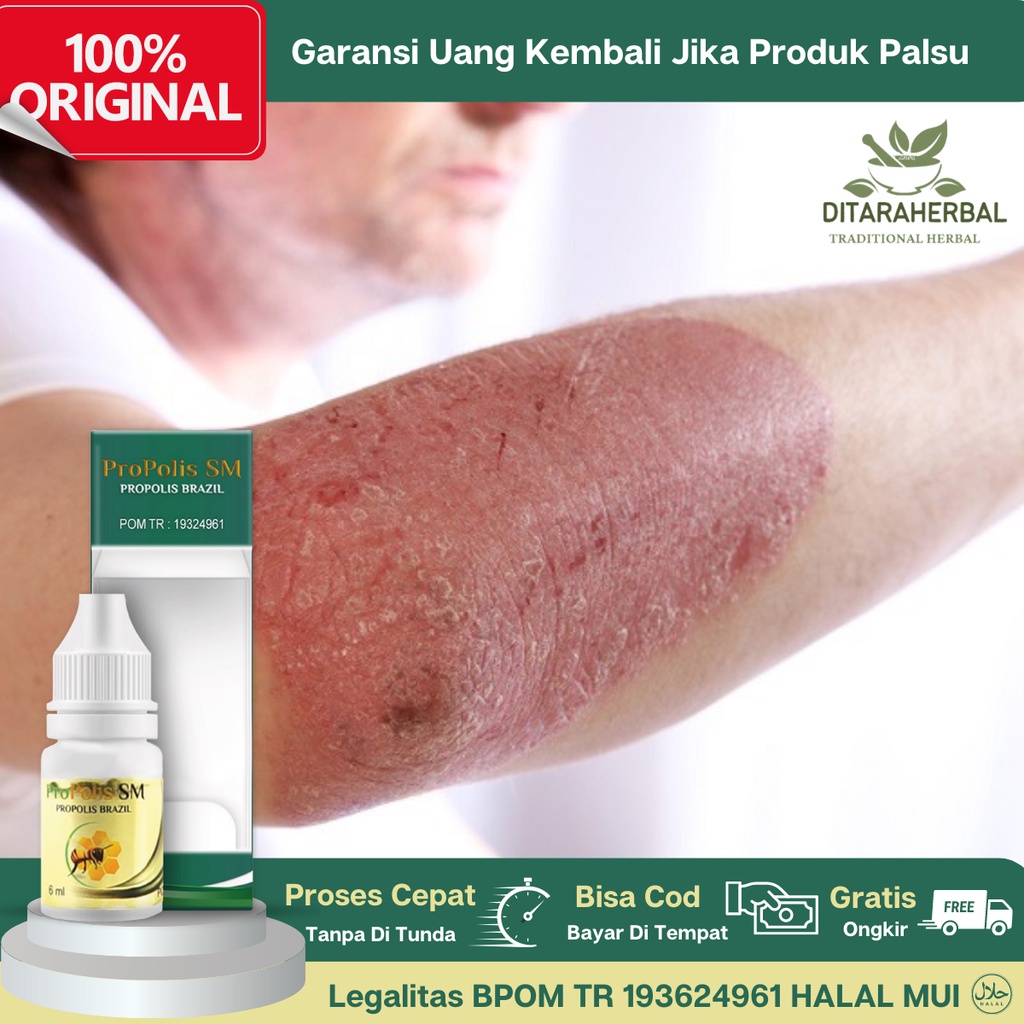Obat Selulitis, Obat Infeksi Bakteri Di kulit Wajah, Lengan, Mata, Perut Dan Kaki, Obat Bintik Binti