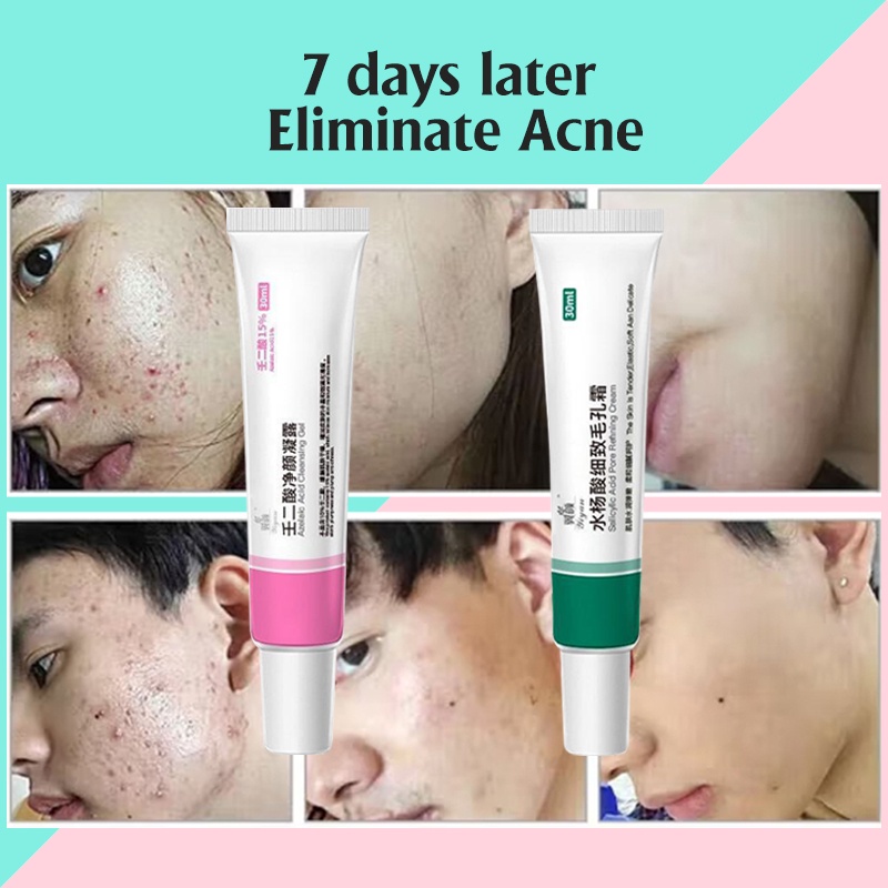 Acne gel jerawat Mengecilkan Pori pori besar Serum wajah 30G Menyegarkan kontrol minyak komedo mengecilkan pori-pori Meningkatkan jerawat dan kulit kasar Melembabkan dan meremajakan Menghilangkan jerawat, komedo, pori-pori besar