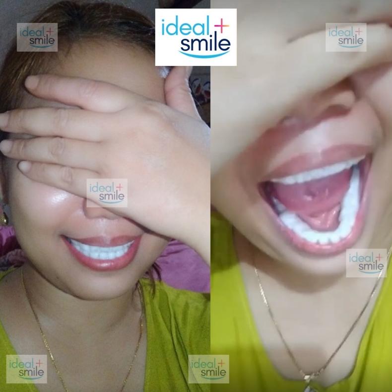 IDEAL SMILE GIGI PALSU ATAS BAWAH GIGI PALSU LEPAS PASANG VENEER snap on smile