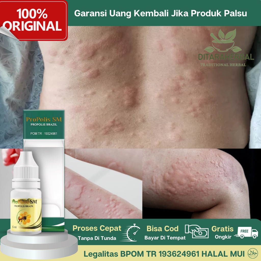 Obat Biduran, Obat Biduran Alergi, Obat Alergi Dingin Gatal, Obat Alergi Gatal Kulit, Obat Biduran G