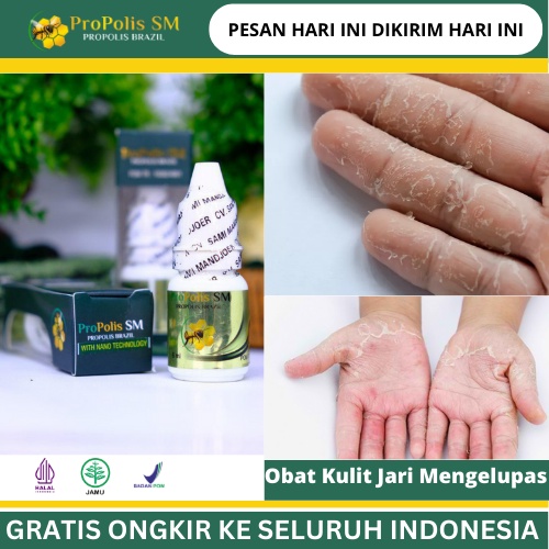 Obat Kulit Jari Mengelupas, Obat Jari Tangan Kering, Telapak Tangan Kasar, Obat Kulit Jari Bersisik 