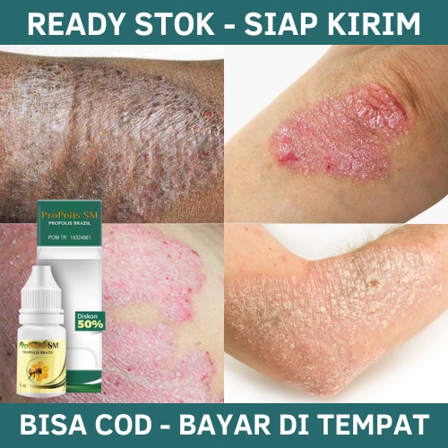 Obat Eksim Kering Menahun, Obat Herbal Eksim Kering, Obat Eksim, Obat Eksim basah, Obat Eksim Parah,
