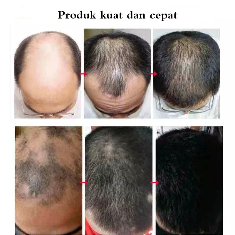 Vitamin rambut rontok Serum rambut rontok Hair tonic rambut rontok Perawatan rambut rontok 30ml Efektif membantu menumbuhkan/menguatkan rambut untuk mencegah kerontokan/membantu rambut menjadi lebih gelap dan cerah