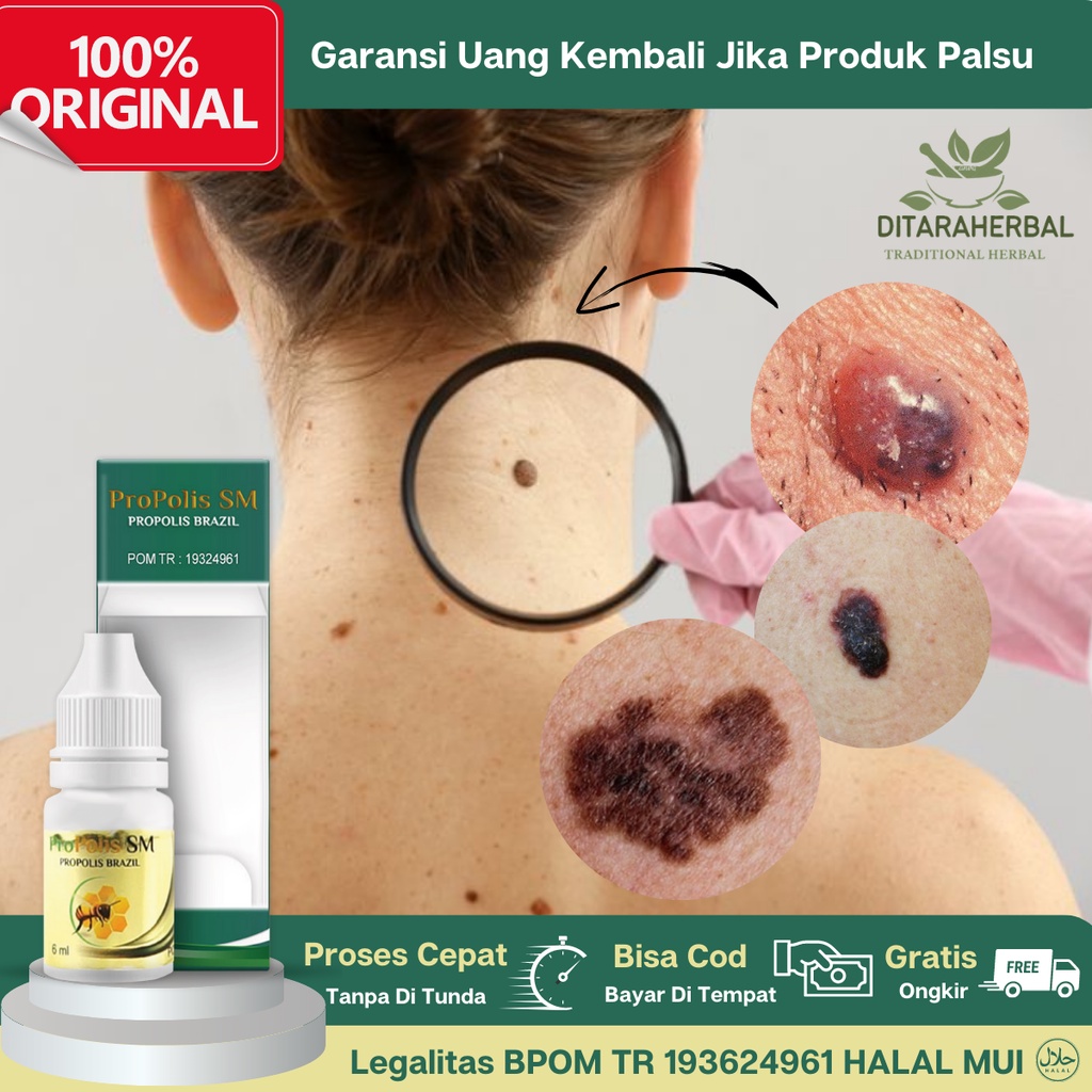Obat TKanker Kulit, Obat Kanker Melanoma, Obat Herbal Kanker Kulit, Obat Kanker Kulit di Wajah dan T
