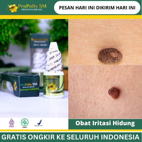 Obat Perontok Tahi Lalat Kasar, Obat menghilangkan tahi lalat, Obat Tahi Lalat Menahun, Obat Daging 
