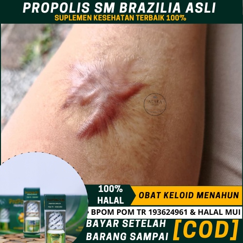 Obat Penghilang Keloid Yang Sudah Lama, Obat Keloid Menahun, Salep Untuk Keloid, Penghilang Bekas Lu