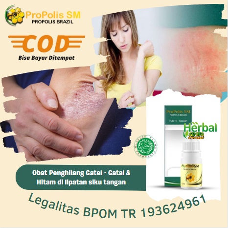 Obat Penghilang Gatel - Gatal & Hitam di lipatan siku tangan | Eksim - psoriasis - Herbal Untuk derm