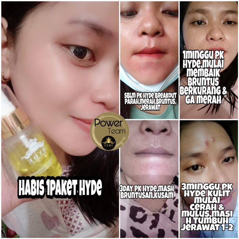 Hyde Beauty Skincare Paket Glowing isi 4 Toner Original Hyde Hayde Beauty Skincare Pemutih Pencerah Wajah Glowing Flek Hitam Jerawat Acne BPOM Distributor Hyde Lampung Jakarta Metro
