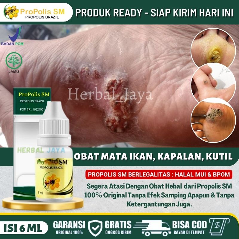 Obat Mata Ikan Pada Anak Tanpa Perih 100% ASLI, Obat Menghilangkan Mata Ikan di Telapak Kaki & Tanga