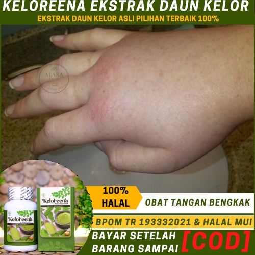 Obat Tangan Bengkak, Pengempis Tangan Bengkak, Penghilang Bengkak Pada Tangan, Obat   Jari Tangan Be
