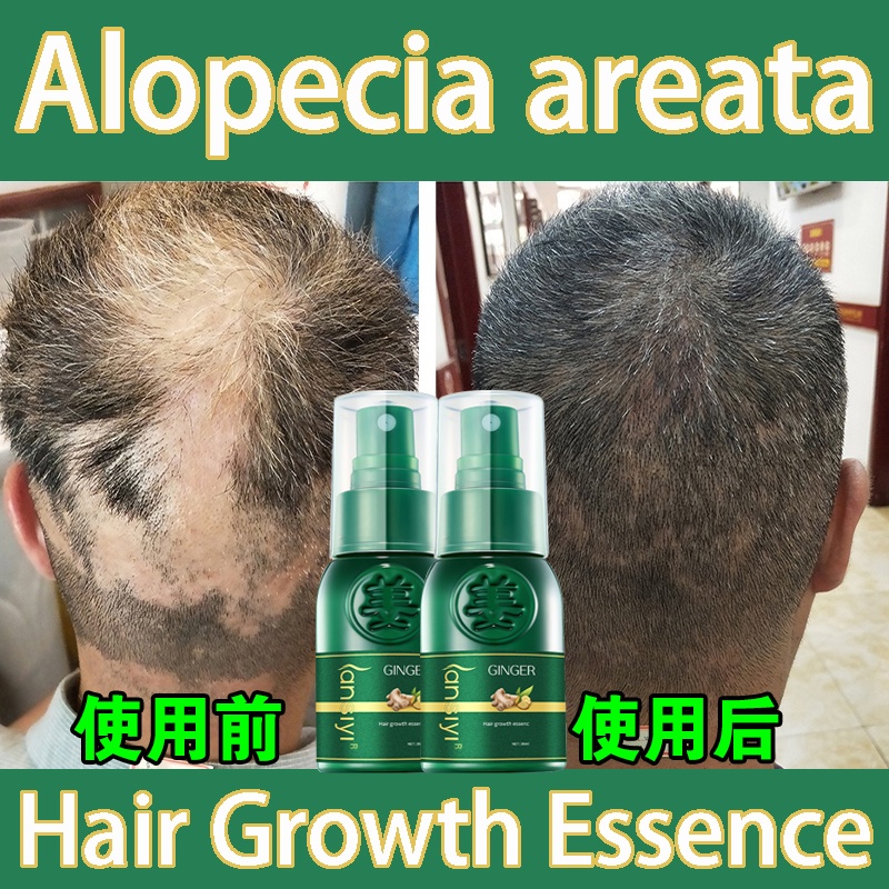 Ginge Hair Growth Essence HAIR TREATMENT Penumbuh Pemanjang Esensi Semprotan jahe 30ml Botak Rontok germinal rambut Perawatan Anti-ketombe pertumbuhan rambut cepat