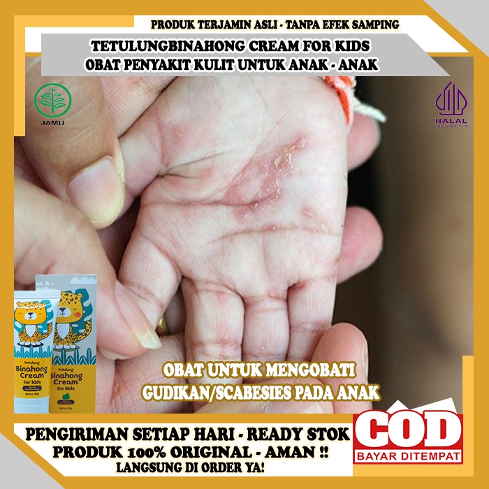 Obat Gatal Scabesies Pada Anak, Obat Oles Budug, Borok Pada Anak, Obat Oles Scabies Manusia Pada Ana