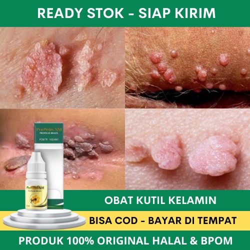 Obat Kutil Kelamin, Obat Kutil Anus Pria / Wanita, Obat Kutil Kelamin HPV, Obat Kutil Kelamin Pria, 