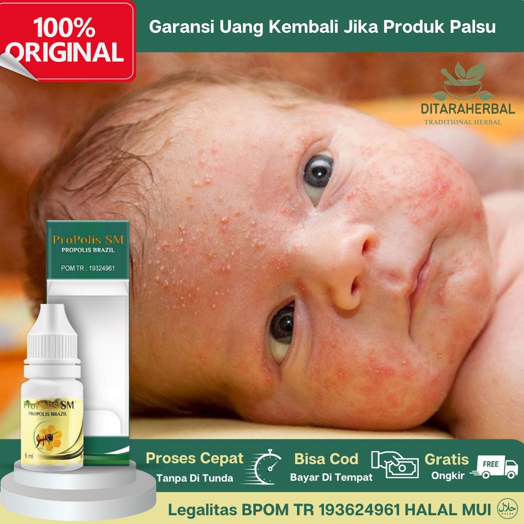 Obat Iritasi Kulit, Obat Kulit Kemerahan, Obat Ruam Kulit, Obat Alergi Kulit, Obat Bintik Bintik Mer