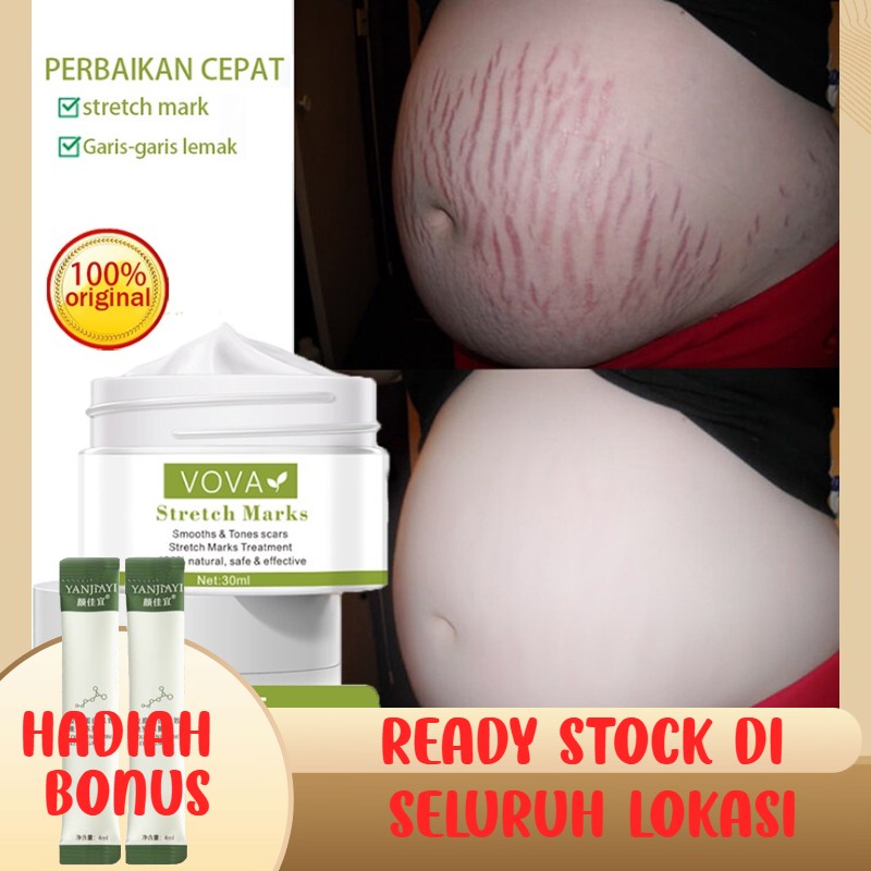Krim Kehamilan StretchMark Cream krim bekas luka 30ml Pengencang Kulit Solusi Perut Gatal dan Anti S