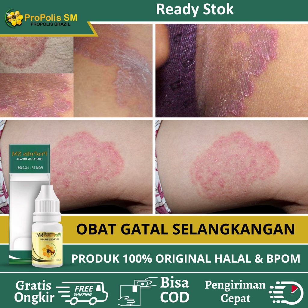 Obat Selangkangan Hitam, Obat Gatal Selangkangan, Obat Selangkangan Gatal Hitam, Obat Penghilang Hit