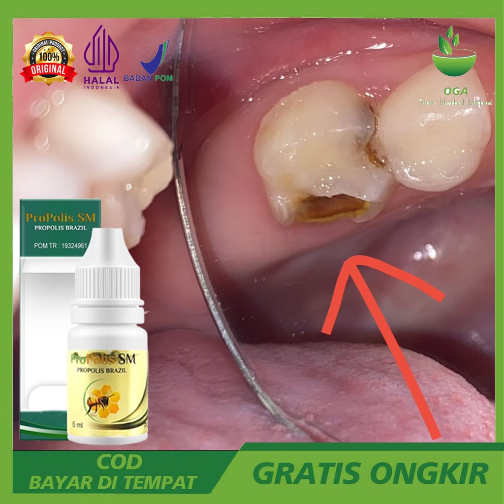 Pembasmi Ulat Gigi Menghilangkan Ulat di Gigi Penguaran Ulat Gigi Perontok Akar Gigi Berlubang Caira