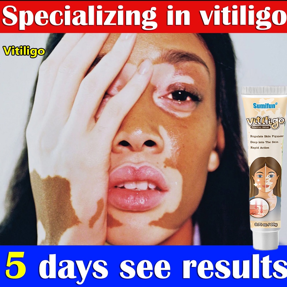 Pengobatan Vitiligo obat vitiligo ampuh /protopic Vitiligo alep vitiligo, panu, biang keringat, sale