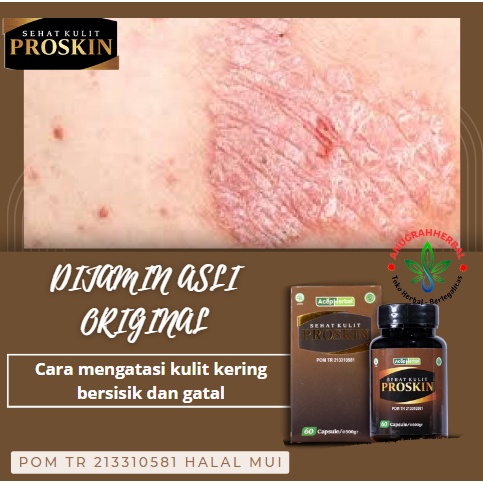Cara mengatasi kulit kering bersisik dan gatal, Penghilang Kulit Gatel, kulit kering, dermatitis ato