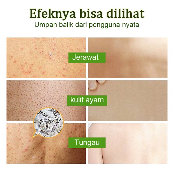 Acne body wash sabun jerawat sabun mandi 500ml Apsintus shower gel, sabun pemutih badan, anti gatal, anti bakteri, anti jerawat, tungau punggung, wangi tahan lama, kering/gatal/biang keringat