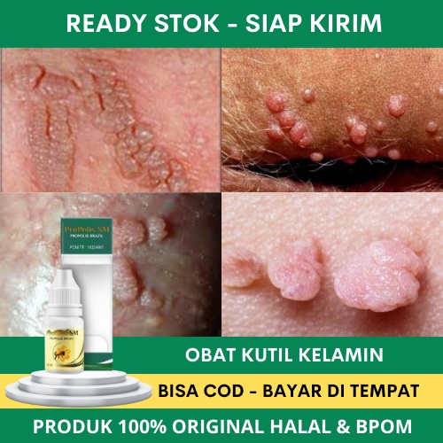 Obat Kutil Kelamin, Obat Kutil di Kelamin, Obat Perontok Kutil Kelamin, Obat Oles Perontok Kutil, Ob