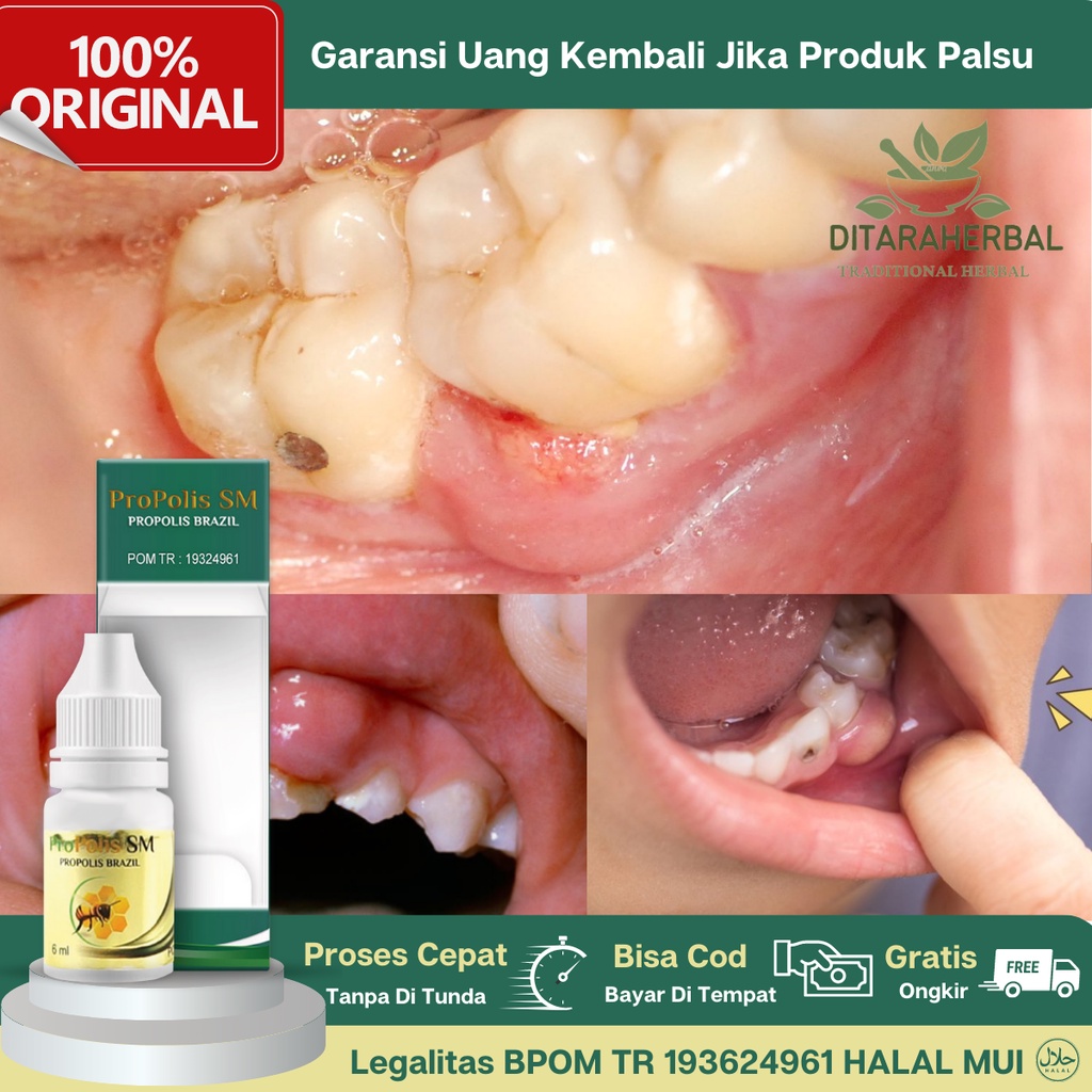 Obat Gusi Berdarah, Obat Tetes Gusi Berdarah, Obat Gusi Sensitif, Obat Gusi Ngilu, Obat Radang Gusi,