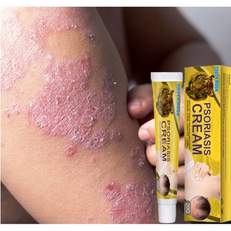 Salep Gatal Psoriasis Ampuh Mengatasi Psoriasis,Eksim, Kemerahan, Peradangan dan Iritasi oleh Jamur