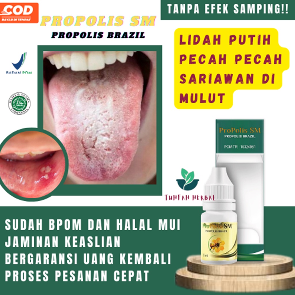 Obat Lidah Putih Berjamur Pecah Pecah Luka Mati Rasa Panas Dalam Obat Sariawan Mulut Lidah Bibir Oba
