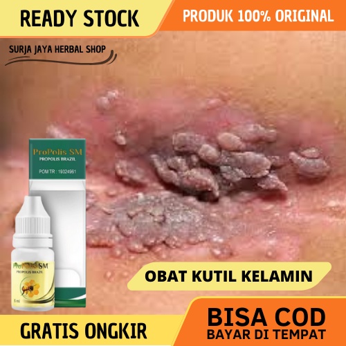 Obat Kutil Kelamin, Obat Kutil Kelamin Hpv, Salep Kutil Kelamin, Obat Kutil Kemaluan, Obat Penghilan