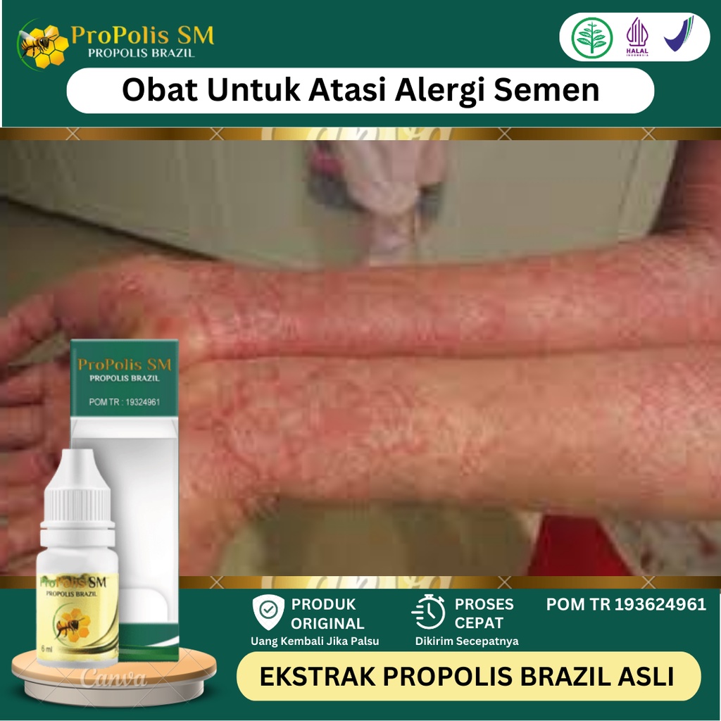 Obat Alergi Semen, Obat Gatal Kulit Alergi Semen, Obat Kulit Ruam Kemerahan Akibat Alergi Semen, Oba