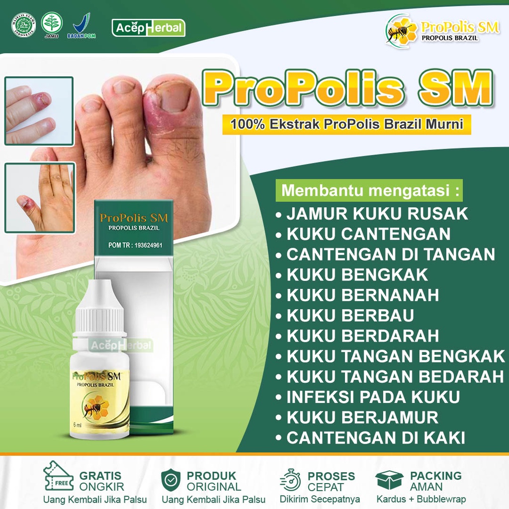 Obat Cantengan Jempol Kaki dan Tangan Jamur Kuku Rusak Bengkak Berdarah Bernanah Herbal Propolis SM