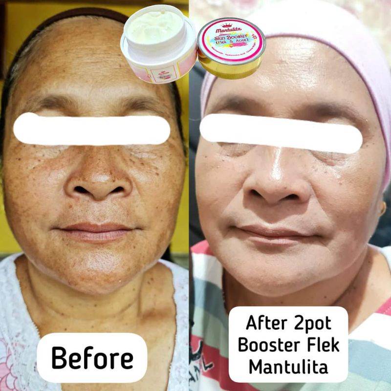 Skin Booster Flek dan Jerawat Mantulita glow skincare