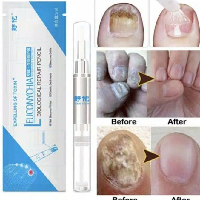 Salep Kuku Kaki Dan Tangan Cantengan Obat Jamur Kuku Leuconychia Cream